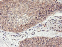 ab119808 at 1/150 dilution staining DPP9 in Paraffin-embedded Human Bladder carcinoma tissue by Immunohistochemistry.