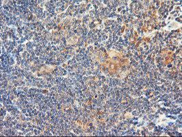 ab119808 at 1/150 dilution staining DPP9 in Paraffin-embedded Human Lymphoma tissue by Immunohistochemistry.