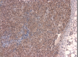 The image above is a xenograph of human cancer cells implanted into a nude mouse and allowed to grow for about three weeks. Notice only the human cancer cells expressed this antigen. This picture was kindly submitted as part of the reveiw by Dean Wilkie.