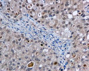 Immunohistochemical analysis of paraffin-embedded, formalin-fixed Human ovarian carcinoma tissue labeling DRIL1 with ab169787 at 1/50 dilution.