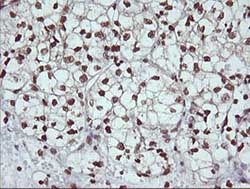 Immunohistochemical analysis of paraffin-embedded Human kidney carcinoma tissue labelling DNM1L with ab140494 at 1/150 dilution.