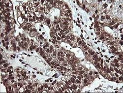 Immunohistochemical analysis of paraffin-embedded Human ovary adenocarcinoma tissue labelling DNM1L with ab140494 at 1/150 dilution.