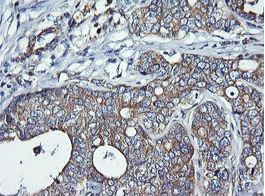Immunohistochemical analysis of paraffin embedded Human breast adenocarcinoma tissue labeling DNM1L with ab150336 at 1/150 dilution.