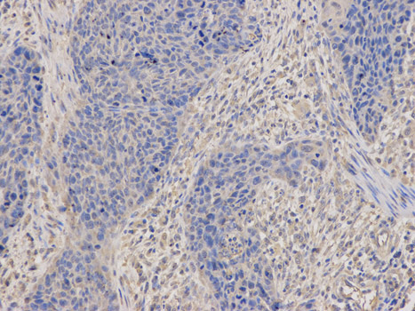 Immunohistochemistry (Formalin/PFA-fixed paraffin-embedded sections) analysis of human esophageal cancer tissue labelling DRP1 with ab180769 at 1/100. Magnification: 200x.