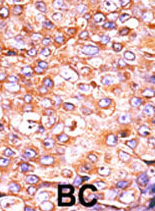 Ab60229 (1:50) staining human DUSP4 in human breast carcinoma tissue by immunohistochemistry using formalin fixed, paraffin embedded tissue. Formalin-fixed and paraffin-embedded human cancer tissue reacted with the primary antibody, which was peroxidase-conjugated to the secondary antibody, followed by AEC staining. BC = breast carcinoma