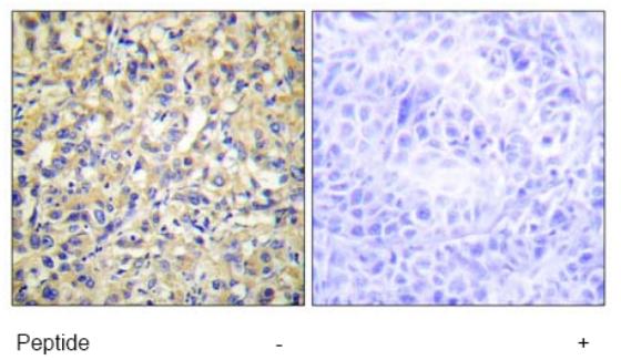 Immunohistochemistry analysis of paraffin embedded human liver carcinoma tissue using ab70129 at 1/50 dilution, with and without the immunising peptide.