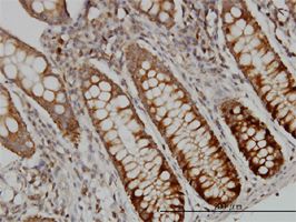 DUT-N antibody (ab54942) used in immunohistochemistry at 1ug/ml on formalin fixed and paraffin embedded human colon.