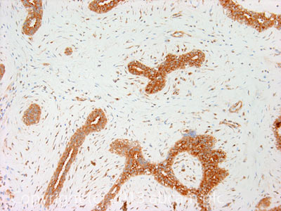 IHC image of Dynamitin staining in Human breast fibroadenoma formalin fixed paraffin embedded tissue section, performed on a Leica BondTM system using the standard protocol F. The section was pre-treated using heat mediated antigen retrieval with sodium citrate buffer (pH6, epitope retrieval solution 1) for 20 mins. The section was then incubated with ab56687, 10µg/ml, for 15 mins at room temperature and detected using an HRP conjugated compact polymer system. DAB was used as the chromogen. The section was then counterstained with haematoxylin and mounted with DPX.For other IHC staining systems (automated and non-automated) customers should optimize variable parameters such as antigen retrieval conditions, primary antibody concentration and antibody incubation times.