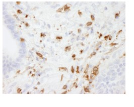 Detection of Human Coronin 1a by Immunohistochemistry on formalin fixed paraffin embedded section of Human stomach adenocarcinoma using 1/250 ab84504. Detection: DAB staining
