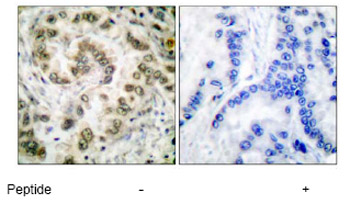 Immunohistochemical analysis of E2F4 in paraffin embedded human lung carcinoma tissue using ab53060 at a 1/50 dilution.Left image untreated.Right image treated with peptide.