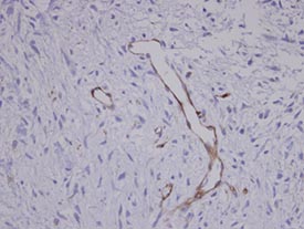 ab96266 at 1/100 dilution stainin Coronin 3 in paraffin-embedded Human Sarcoma meta to brain Blood Vessel.