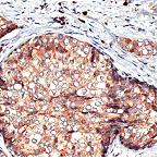 ab52042, at dilution of 1/100, staining EBAG9 in formalin fixed paraffin embedded human breast carcinoma tissue by Immunohistochemistry.
