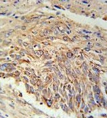 Immunohistochemical analysis of formalin fixed, paraffin embedded Human lung carcinoma tissue labeling EBPL with ab175513 at 1/50 followed by peroxidase conjugation of the secondary antibody and DAB staining.