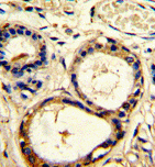 ab85507, at a 1/50 dilution, staining Cortactin in formalin fixed, paraffin embedded Human breast carcinoma tissue by Immunohistochemistry, followed by peroxidase conjugated secondary antibody and DAB staining.