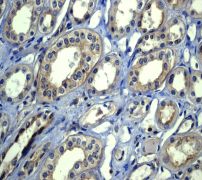 ab75748 at 1/100 dilution staining EEF2 in human kidney carcinoma tissue.