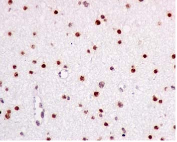 Immunohistochemical analysis of paraffin-embedded Human glioblastoma staining COUP TF1 using ab181137 at 1/100. Prediluted HRP Polymer for Rabbit IgG was used as a secondary antibody, and Hematoxylin for counterstaining.