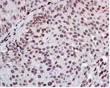 Immunohistochemical analysis of paraffin-embedded Human transitional cell carcinoma staining COUP TF1 using ab181137 at 1/100. Prediluted HRP Polymer for Rabbit IgG was used as a secondary antibody, and Hematoxylin for counterstaining.