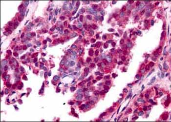 ab6054 at 10 µg/ml staining human ovarian cancinoma.