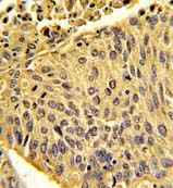 Immunohistochemical analysis of formalin-fixed, paraffin-embedded Human lung carcinoma labelling EHM2 with ab135616 at 1/50 dilution, followed by peroxidase-conjugated secondary antibody and DAB staining.