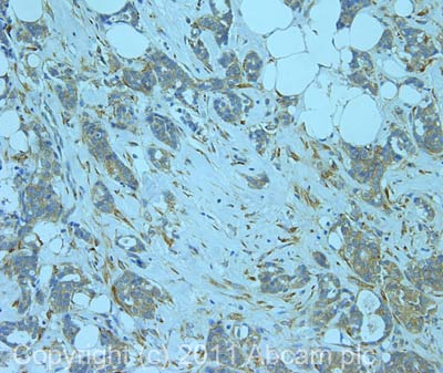 IHC image of ab40744 staining in human breast carcinoma formalin fixed paraffin embedded tissue section, performed on a Leica BondTM system using the standard protocol F. The section was pre-treated using heat mediated antigen retrieval with sodium citrate buffer (pH6, epitope retrieval solution 1) for 20 mins. The section was then incubated with ab40744, 5µg/ml, for 15 mins at room temperature and detected using an HRP conjugated compact polymer system. DAB was used as the chromogen. The section was then counterstained with haematoxylin and mounted with DPX.For other IHC staining systems (automated and non-automated) customers should optimize variable parameters such as antigen retrieval conditions, primary antibody concentration and antibody incubation times.