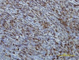 EIF2B2 antibody (ab56424) used in immunohistochemistry at 5ug/ml on formalin fixed and paraffin embedded human lymphoma tissue.