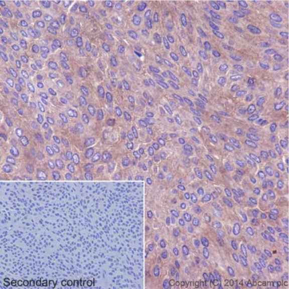 Immunohistochemical analysis of paraffin-embedded Human transitional cell carcinoma of bladder tissue labeling EIF3S1 with ab196018 at 1/250 dilution, followed by Goat Anti-Rabbit IgG H&L (HRP) (ab97051) secondary antibody at 1/500 dilution. Cytoplasm staining on Human transitional cell carcinoma of bladder tissue is observed. Counter stained with Hematoxylin.Secondary control: Used PBS instead of primary antibody, secondary antibody is Goat Anti-Rabbit IgG H&L (HRP) (ab97051) at 1/500 dilution.