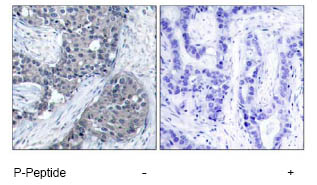 Immunohistochemical analysis of paraffin-embedded human breast carcinoma tissue using ab47605 at a 1/50 dilution.