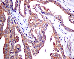 Immunohistochemical analysis of paraffin-embedded Human thyroid carcinoma tissue labeling EIF4EL3 with ab167422 at 1/50 dilution.
