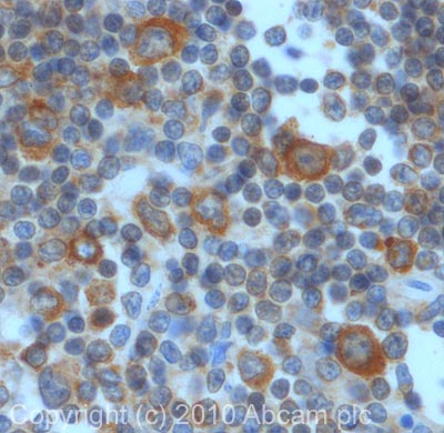 IHC image of ab47625 staining in Hodgekin's Lymphoma formalin fixed paraffin embedded tissue section, performed on a Leica BondTM system using the standard protocol F. The section was pre-treated using heat mediated antigen retrieval with sodium citrate buffer (pH6, epitope retrieval solution 1) for 20 mins. The section was then incubated with ab47625, 5µg/ml, for 15 mins at room temperature and detected using an HRP conjugated compact polymer system. DAB was used as the chromogen. The section was then counterstained with haematoxylin and mounted with DPX. For other IHC staining systems (automated and non-automated) customers should optimize variable parameters such as antigen retrieval conditions, primary antibody concentration and antibody incubation times.