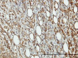 eIF5A antibody (ab54982) used in immunohistochemistry at 1ug/ml on formalin fixed and paraffin embedded human malignant lymphoma, diffuse large B tissue.