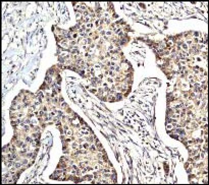 ab32014, at a 1/100 dilution, staining human eIF5A in lung carcinoma by Immunohistochemistry, Paraffin embedded tissue