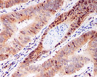 ab126735 at 1/100 dilution, staining eIF5A2 in Formalin fixed Paraffin-embedded Human ovarian carcinoma tissue by Immunohistochemistry.