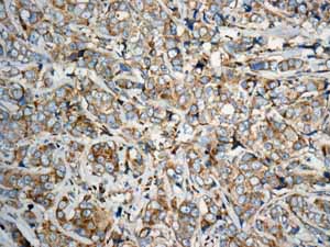 Immunohistochemical analysis of paraffin embedded Human Breast carcinoma tissue using ab150439 showing +ve staining.