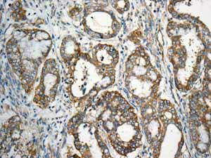 Immunohistochemical analysis of paraffin embedded Human Ovarian carcinoma tissue using ab150439 showing +ve staining.
