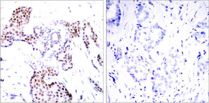 Immunohistochemical analysis of paraffin-embedded breast carcinoma. Left: Using Phospho-ELK-1(Ser389) ab28818; Right: The same antibody preincubated with synthesized phosphopeptide.