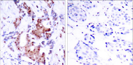 Immunohistochemical analysis of paraffin-embedded breast carcinoma. Left: Using Phospho-ELK-1(Thr417) Antibody (ab28817); Right: The same antibody preincubated with synthesized phosphopeptide.