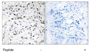 Immunohistochemistry analysis of paraffin-embedded human breast carcinoma tissue using ab69805 at 1:50 dilution.Left image un-treated.Right image treated with immunizing peptide.