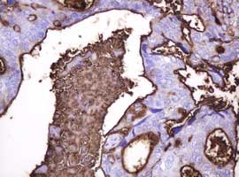 Immunohistochemical analysis of paraffin-embedded Human breast adenocarcinoma tissue labeling EMA with ab156947 at 1/150 dilution.