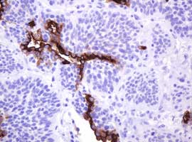 Immunohistochemical analysis of paraffin-embedded Human lung carcinoma tissue labeling EMA with ab156947 at 1/150 dilution