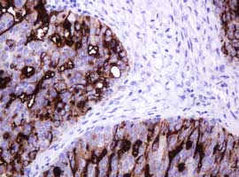 Immunohistochemical analysis of paraffin-embedded Human ovary adenocarcinoma tissue labeling EMA with ab156947 at 1/150 dilution