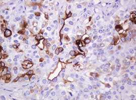 Immunohistochemical analysis of paraffin-embedded Human bladder adenocarcinoma tissue labeling EMA with ab156947 at 1/150 dilution