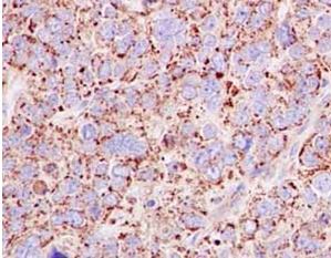Immunohistochemical analysis of paraffin-embedded Human ovarian carcinoma tissue labeling Emi1 with ab184950 at 1/250 dilution followed by pre-diluted HRP-conjugated secondary antibody and counter-stained with Hematoxylin.