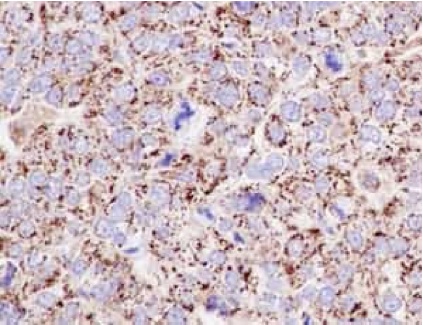 Immunohistochemical analysis of paraffin embedded Human ovarian carcinoma tissue labeling Emi1 with ab187144 at 1/100 with a prediluted HRP Polymer for Rabbit IgG as secondary antibody.