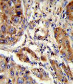 Immunohistochemical analysis of formalin-fixed, paraffin-embedded Human hepatocarcinoma tissue labelling emopamil binding protein with ab135745 at 1/50 dilution followed by peroxidase-conjugated secondary antibody and DAB staining.