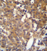 Immunohistochemical analysis of formalin-fixed, paraffin-embedded Human prostate carcinoma tissue labelling Endothelin B Receptor with ab135611 at 1/50 dilution followed by peroxidase-conjugated secondary antibody and DAB staining.