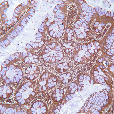 Formalin fixed paraffin embedded human colon carcinoma tissue stained with ab10940 (anti-Cox-2 mouse monoclonal antibody).