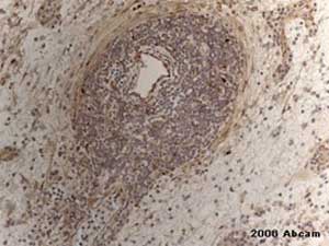 Ab15280 (used neat) staining human B-lineage Lymphoma tissue sections by Immunohistochemistry (Formalin-fixed paraffin-embedded sections). Following heat mediated antigen retrieval, the antibody was incubated with the tissue for 1 hour. Bound antibody was detected using a biotinylated horse anti-mouse and rabbit IgG antibody.This image is courtesy of an Abreview submitted by Francisca Wu on 10 March 2006.See Abreview