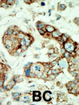 ab5386 staining Eph receptor A2 in human breast carcinoma (BC) tissue by Immunohistochemistry (Formalin/PFA-fixed paraffin-embedded sections). ab5386 was peroxidase-conjugated to the secondary antibody, followed by AEC staining.