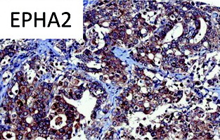 Immunohistochemical analysis of Human gastric adenocarcinoma, staining Eph receptor A2 with ab5386 at 1.25 µg/ml.