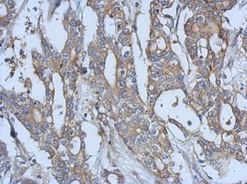 ab126261 at 1/500 dilution staining Eph receptor A3 in paraffin embedded Human gastric carcinoma tissue by Immunohistochemistry.